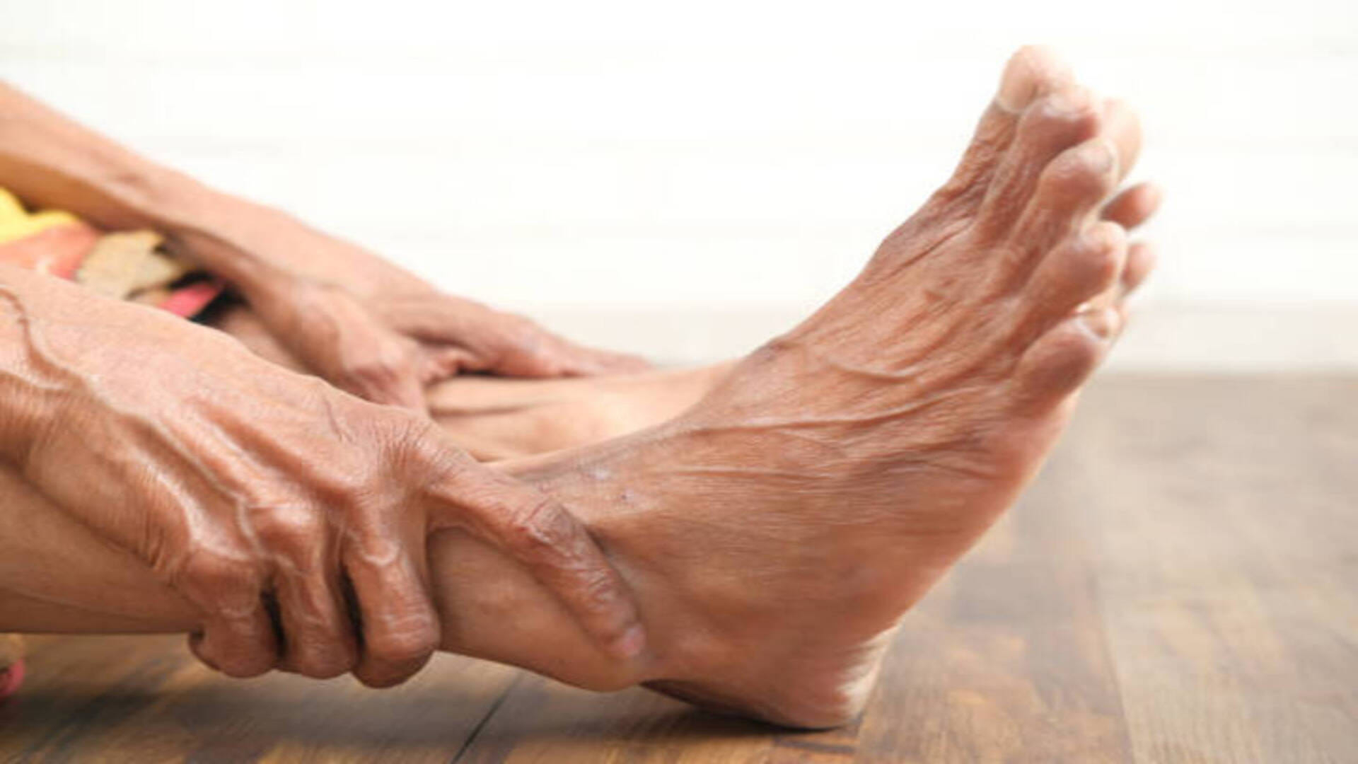 Rich Man's Disease Gout Arthritis Symptoms Causes Treatment And Prevention Of Disease Of Kings