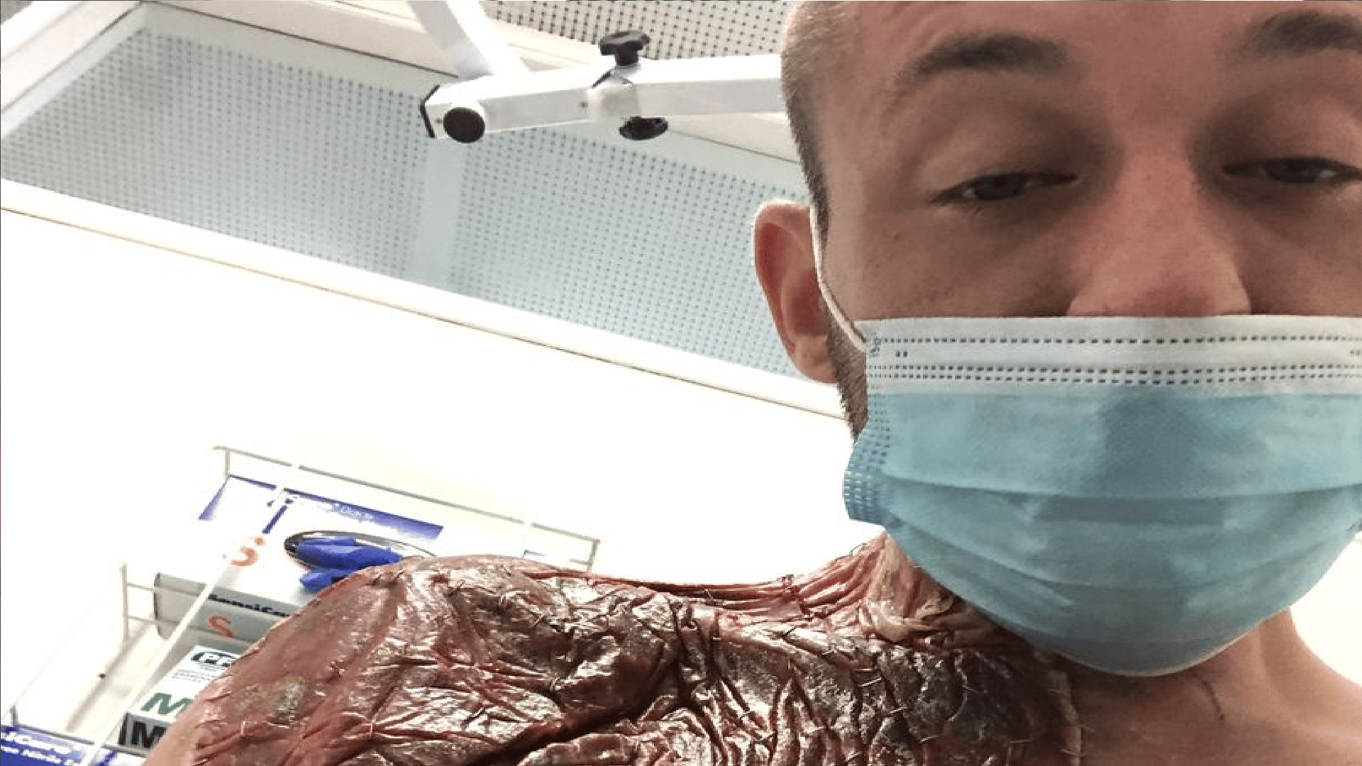 Gym Workout: Man lost arm during dumbbell exercise