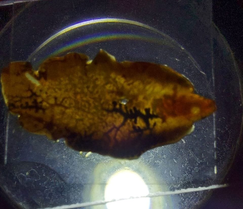 During the operation in Nainital a strange worm was found in place of stone in the gall bladder.