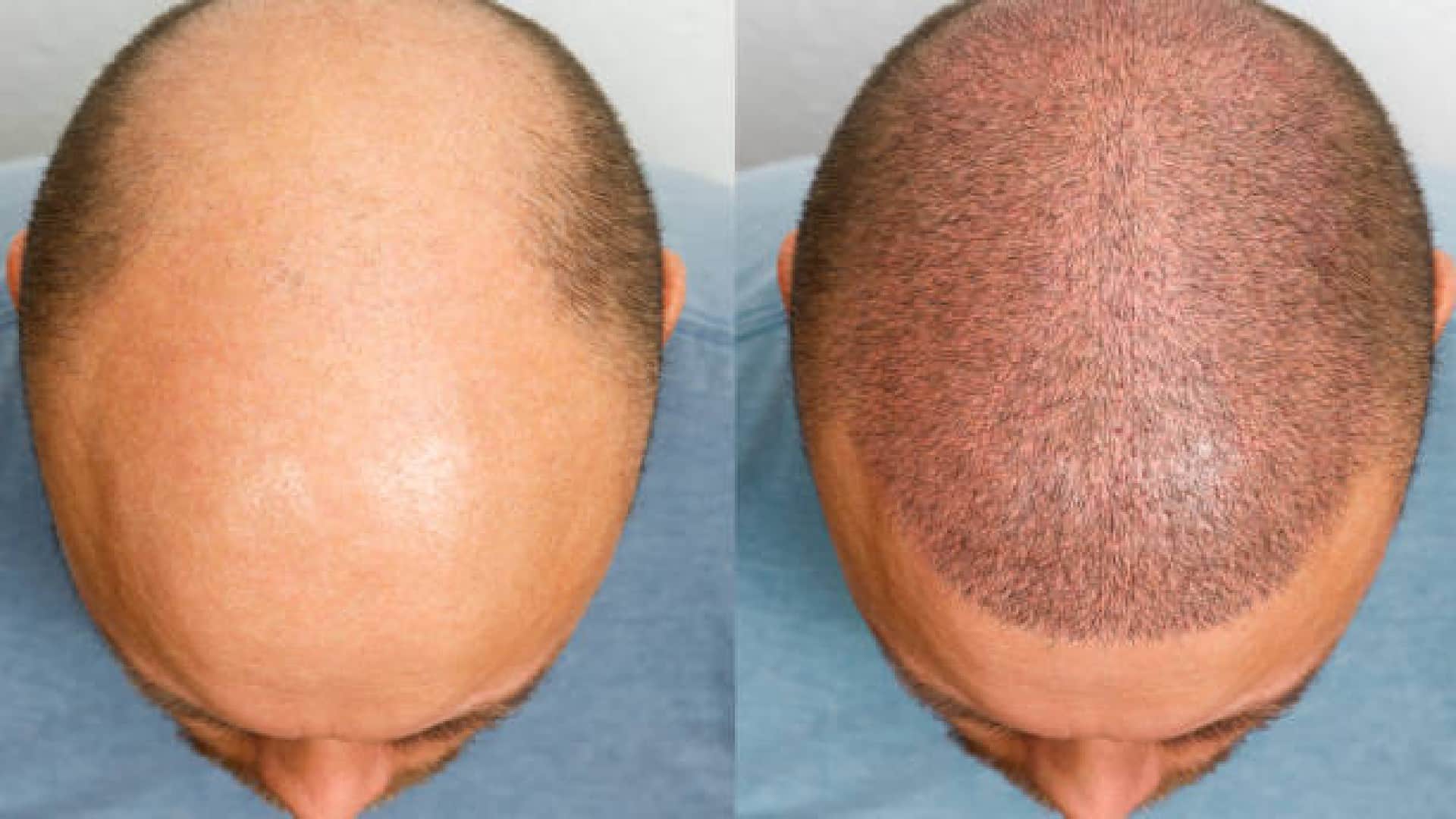 cid fame dayanand shetty aka daya hair transplant surgery share whole process experience with fans