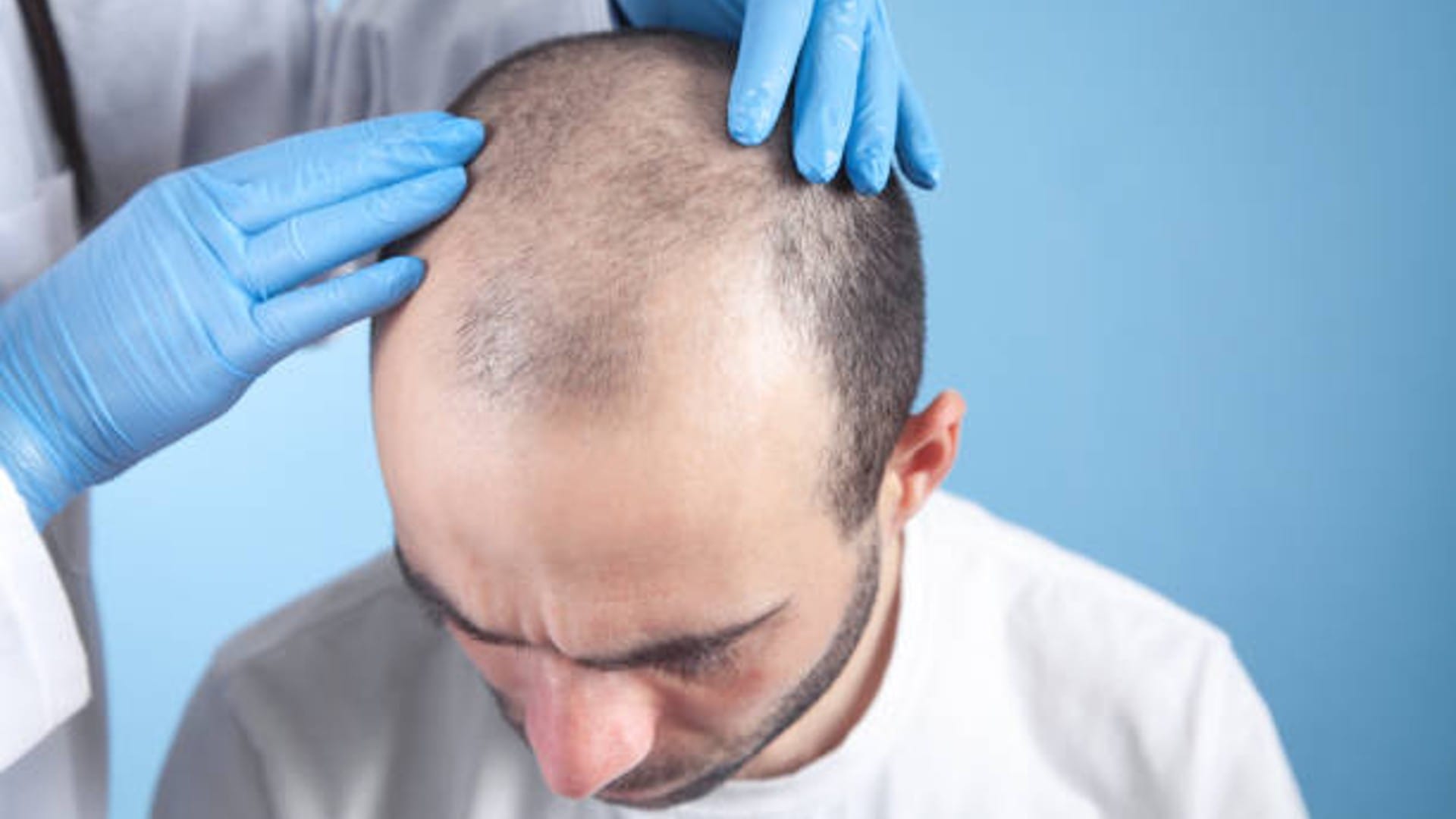 Scientists have discovered TGF-beta  that may lead to the effective treatment of baldness