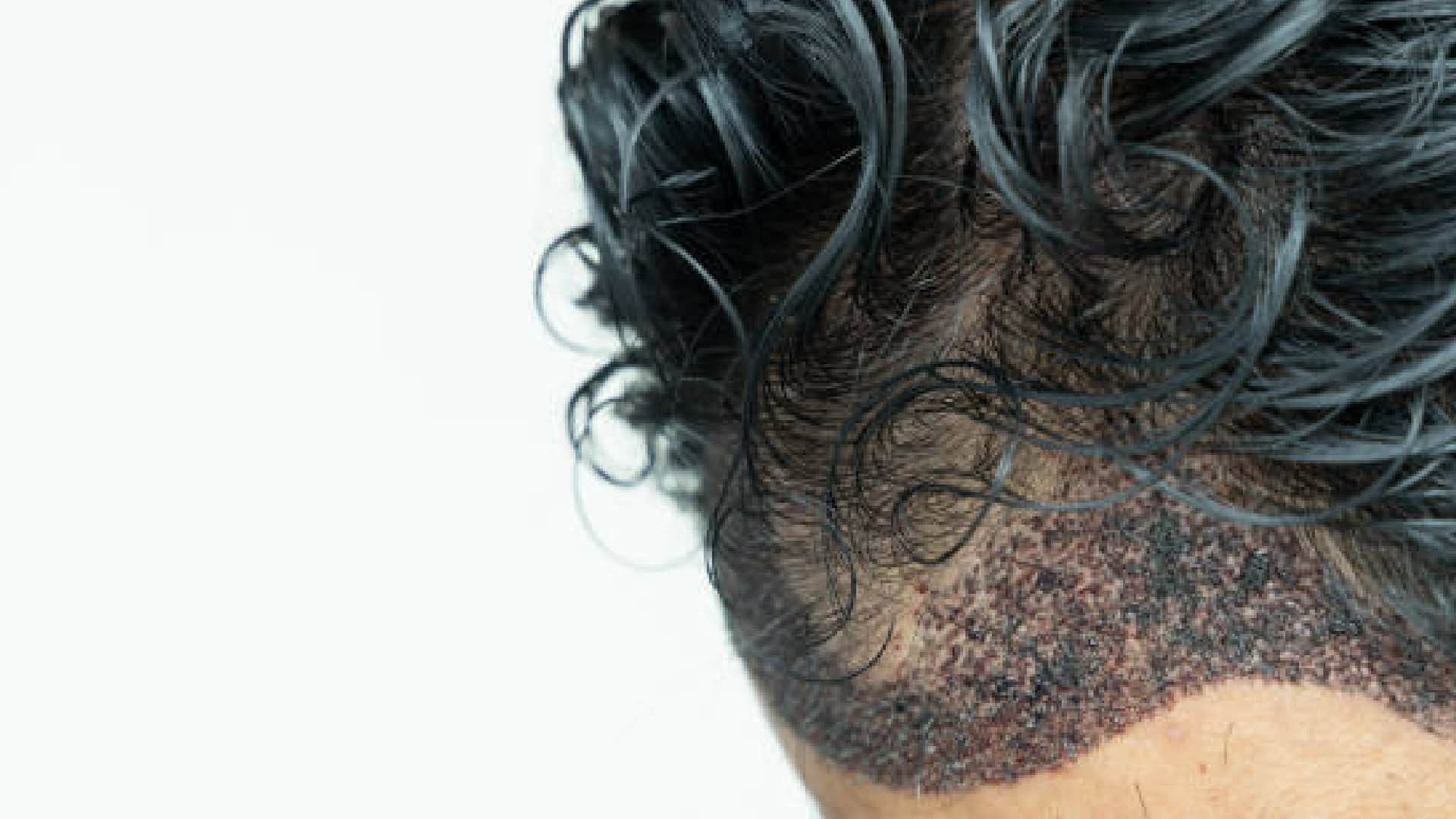 This Country Gives Best Hair Transplant Offers Affordable-Treatment They Receive From Airport News in Hindi