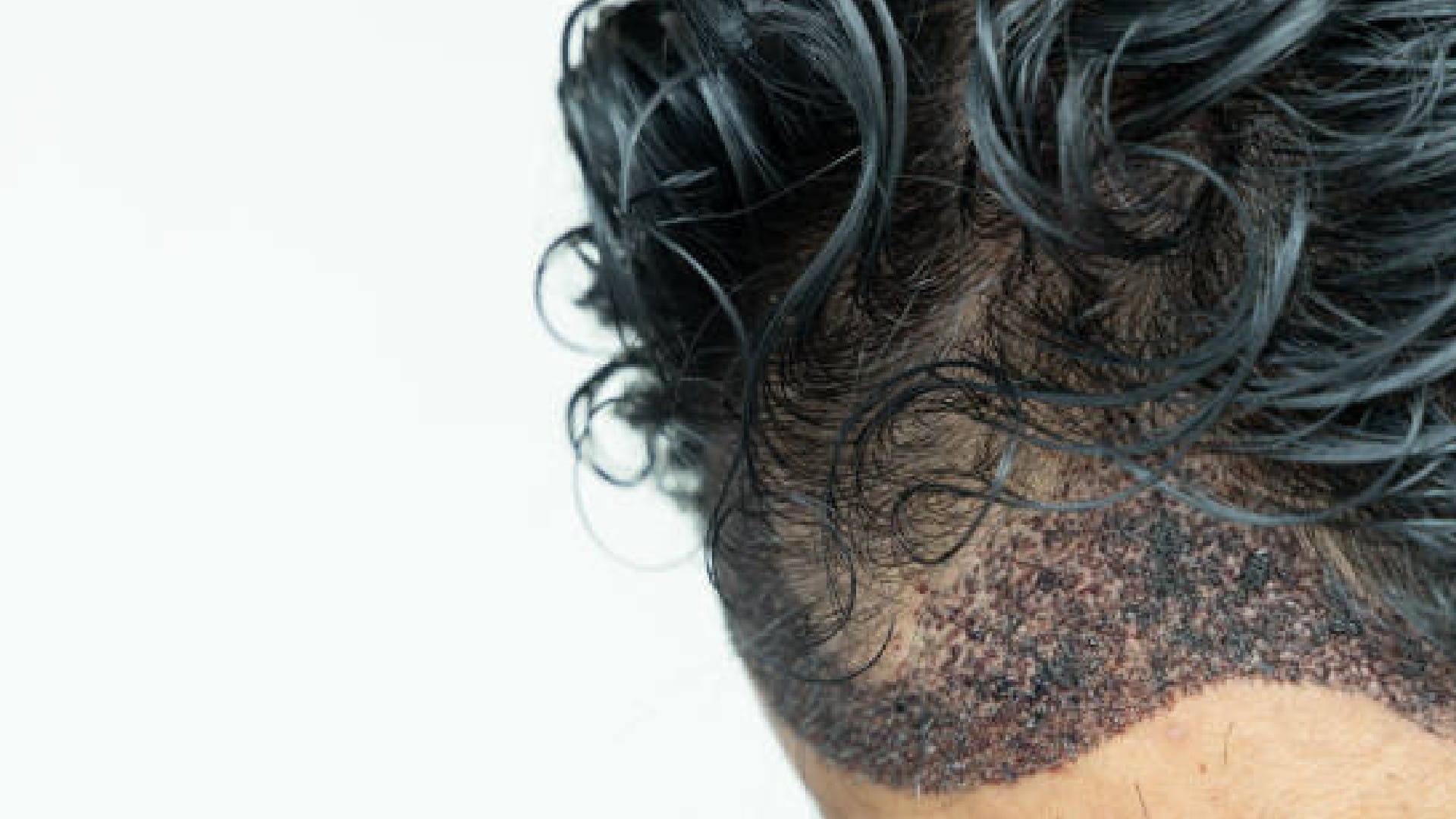 This Country Gives Best Hair Transplant Offers Affordable-Treatment They Receive From Airport News in Hindi