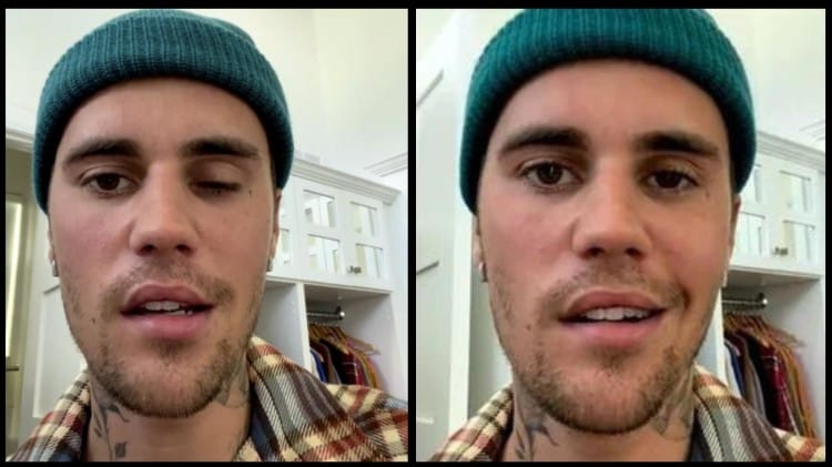 Justin Bieber Reveals Of Face Paralysis Ramsay Hunt Syndrome Latest ...