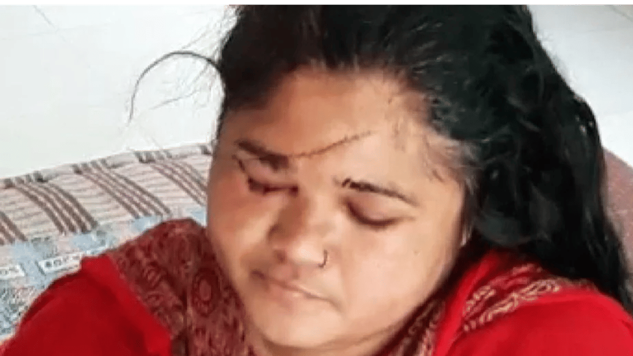 Bhopal: For protesting against molestation in the capital, the manchallenged the woman's face, got more than 100 stitches