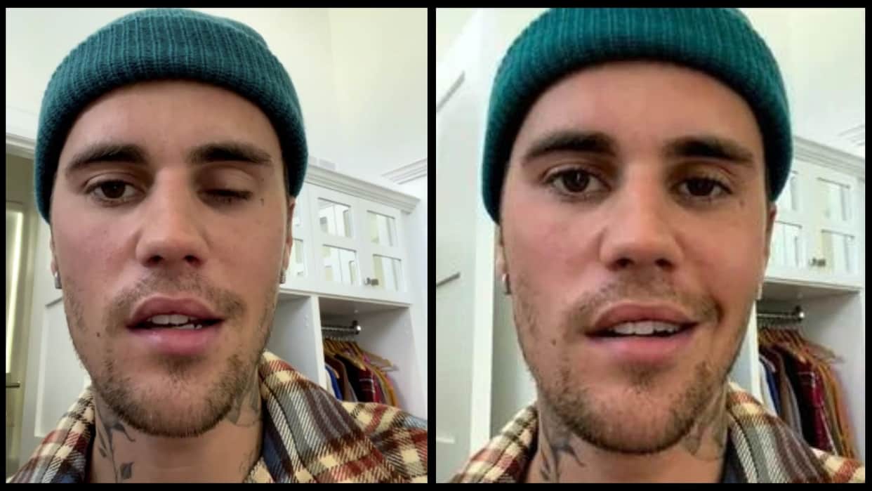 Justin Bieber Reveals of Face Paralysis Ramsay Hunt Syndrome Latest News in Hindi