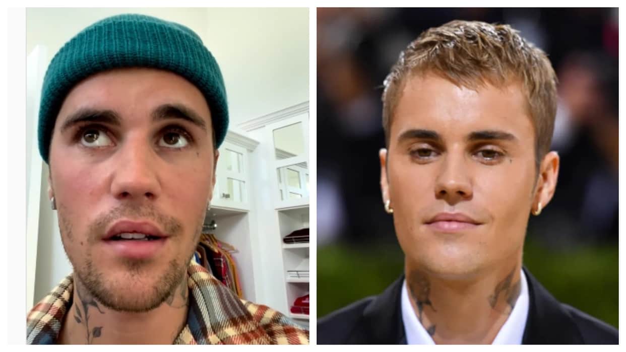 Justin Bieber suffering from Facial paralysis and Ramsay Hunt Syndrome fans are praying for Pop star