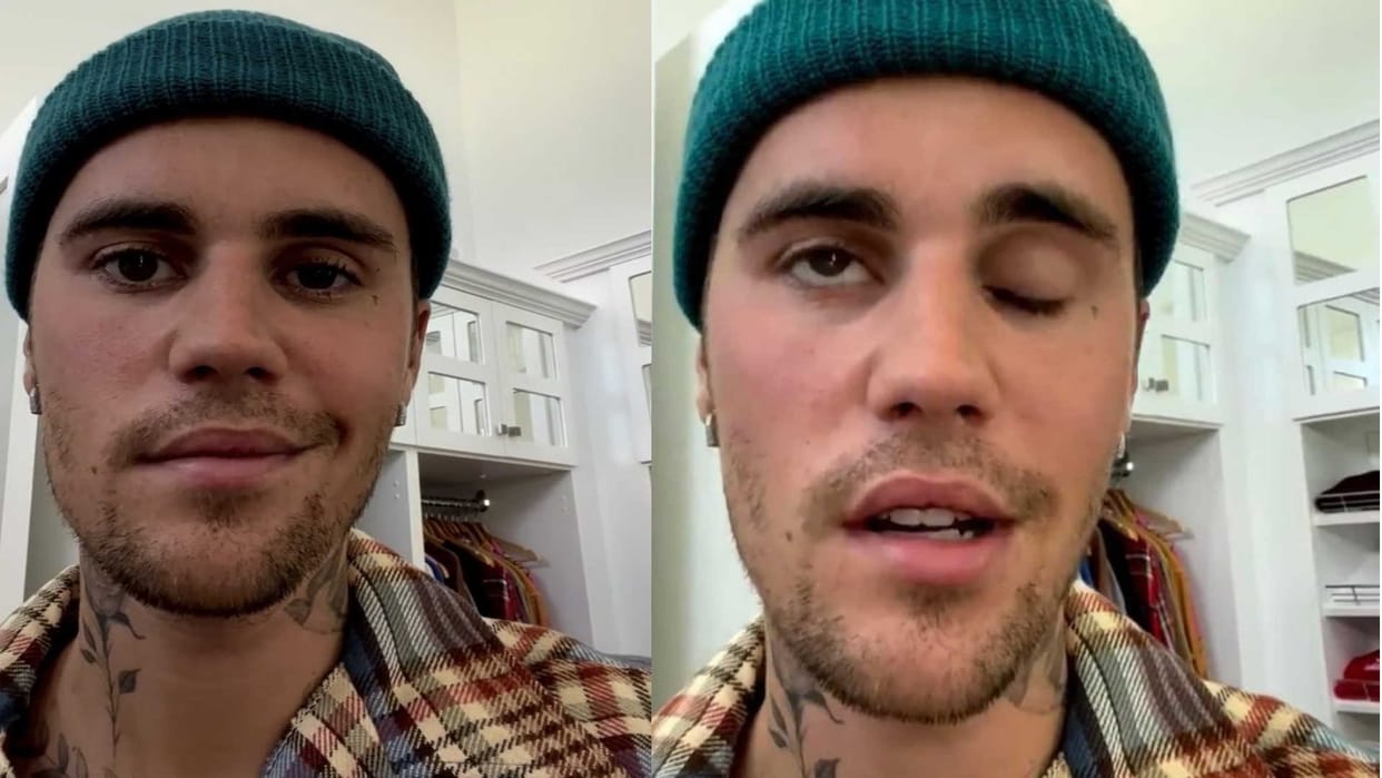 justin bieber latest update, ramsay hunt syndrome causes and treatment in hindi