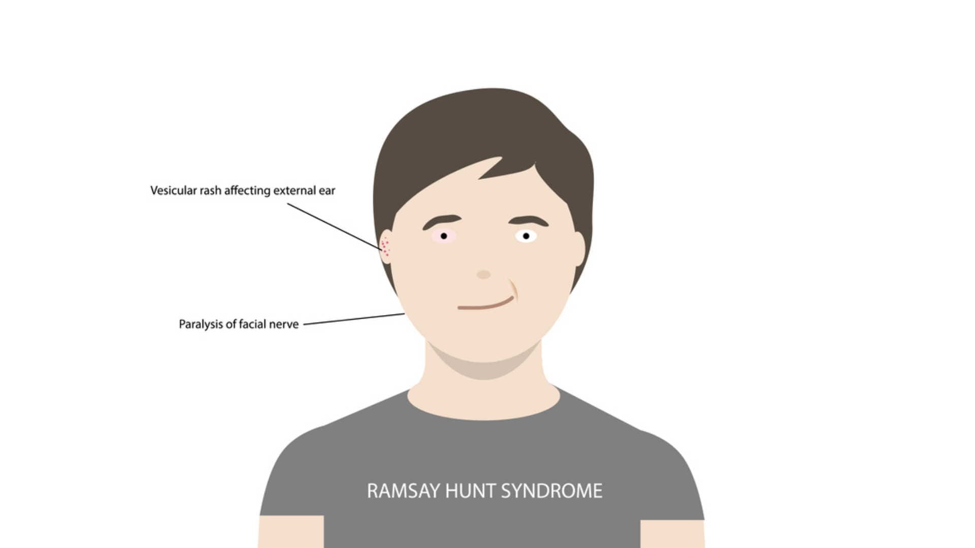 justin bieber latest update, ramsay hunt syndrome causes and treatment in hindi