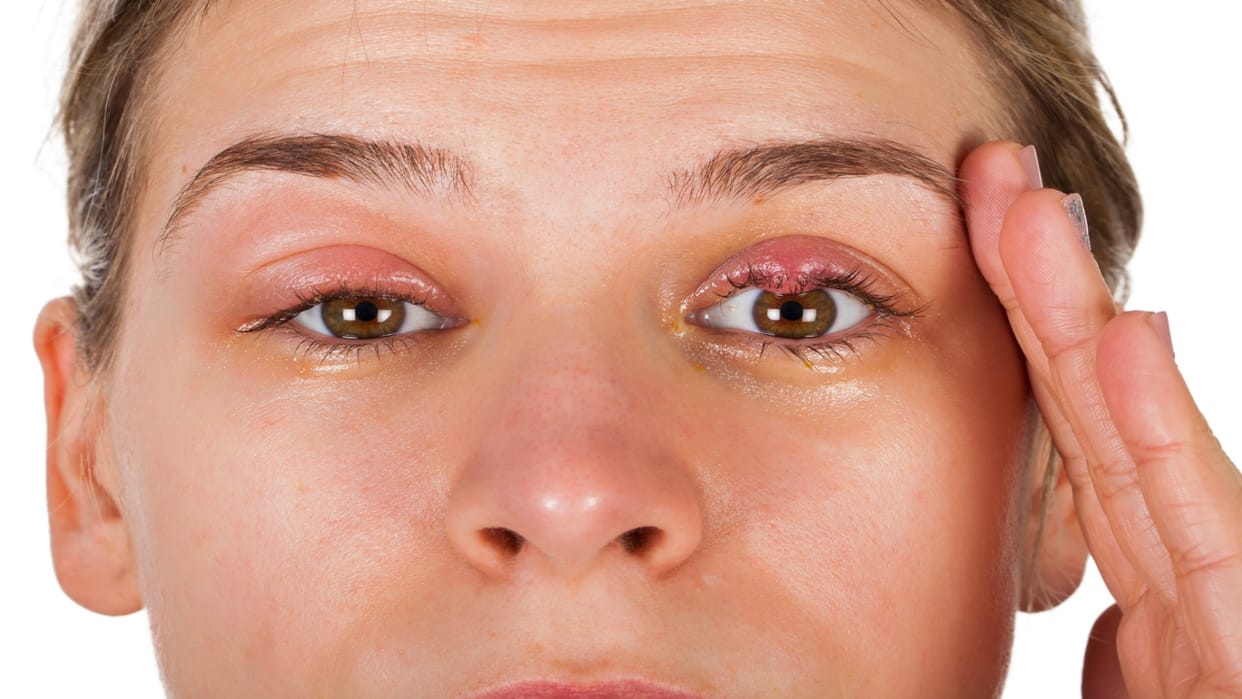 Eye Care Tips For Swollen Eyelid Inflammation Causes Symptoms and Treatment in Hindi