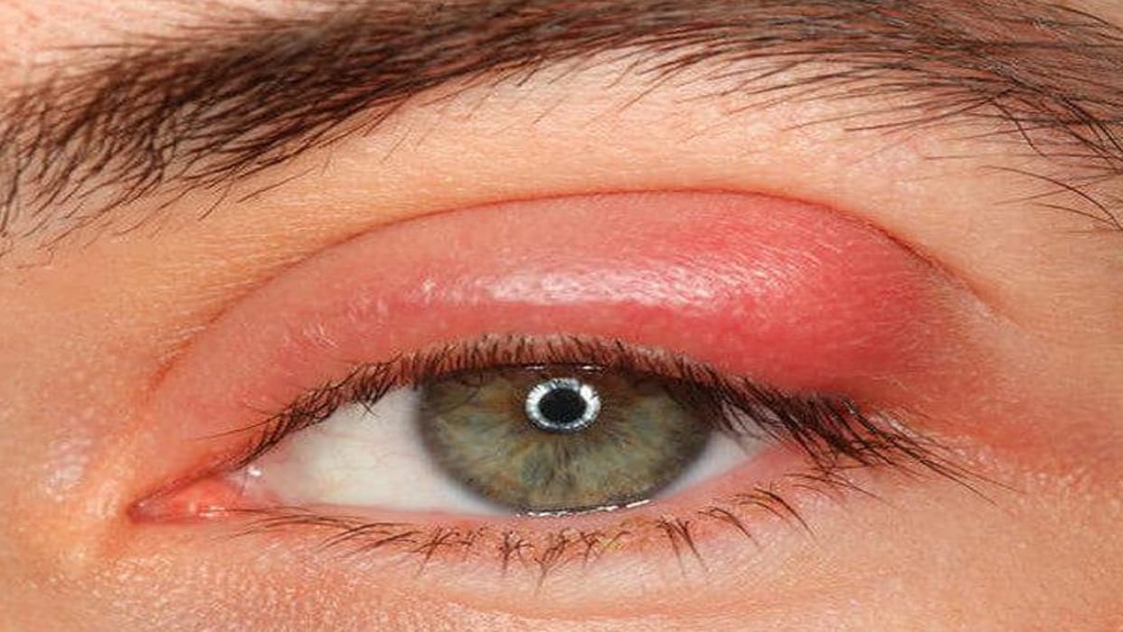 Doctor said in Agra if there burning and itching in eyes then do not put old drops