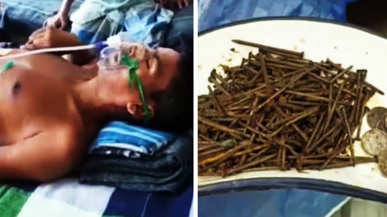Bengal 250 nails 35 coins came out of patient's stomach doctor stunned during surgery