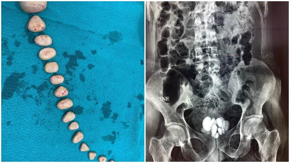 16 stones came out of rahul bladder doctors removed by operation