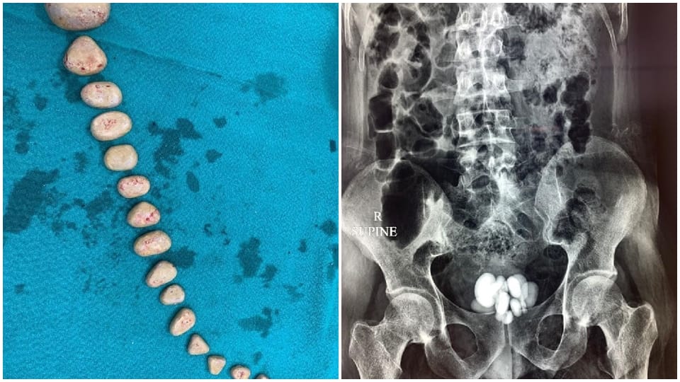 16 stones came out of rahul bladder doctors removed by operation