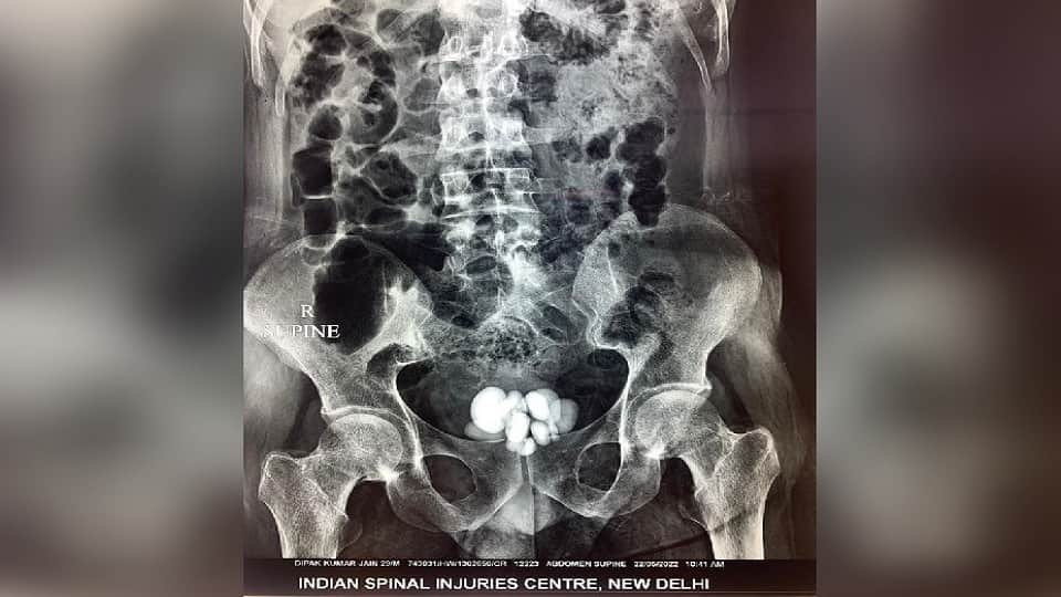 16 stones came out of rahul bladder doctors removed by operation