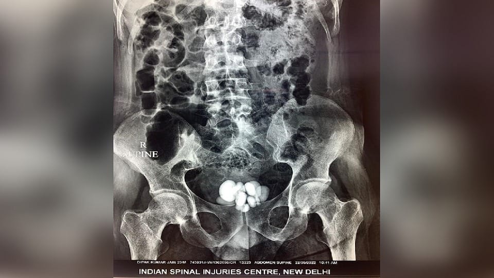 16 stones came out of rahul bladder doctors removed by operation