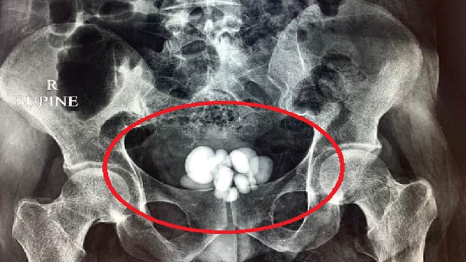 16 stones came out of rahul bladder doctors removed by operation