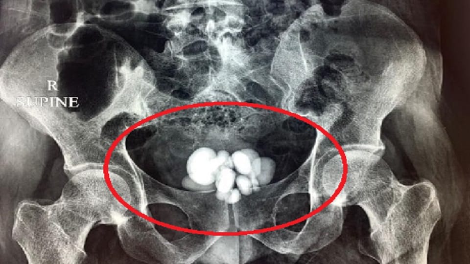 16 stones came out of rahul bladder doctors removed by operation