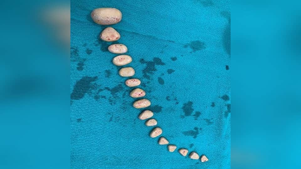 16 stones came out of rahul bladder doctors removed by operation