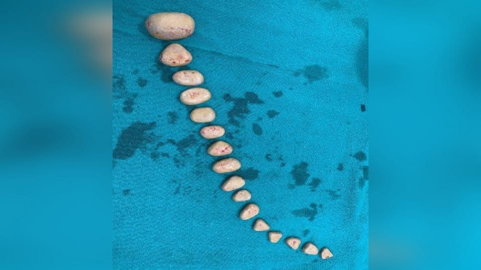 16 stones came out of rahul bladder doctors removed by operation