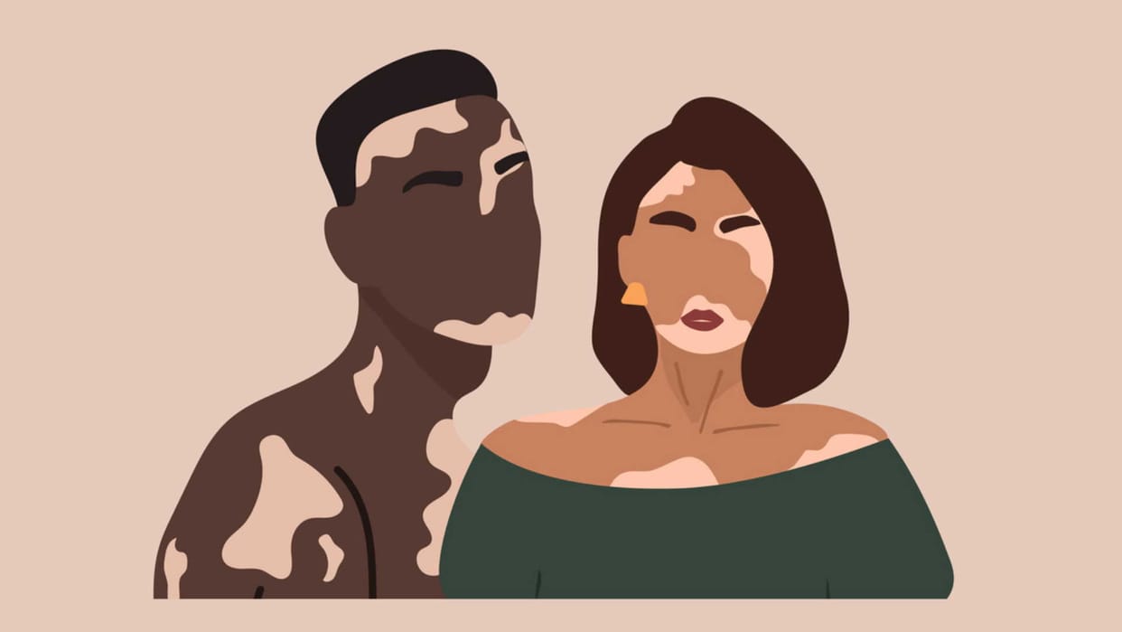 Increasing divorce cases due to vitiligo, social awareness about vitiligo must needed