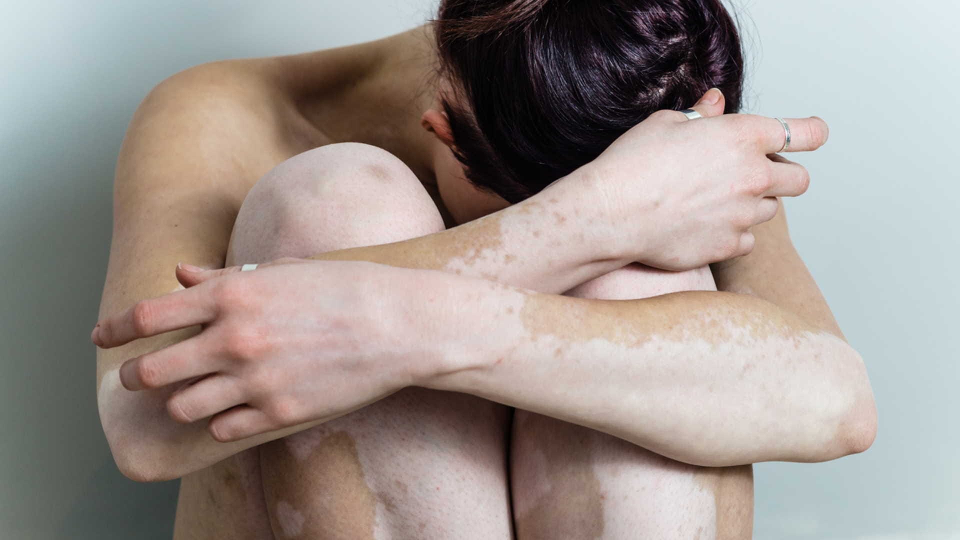 Increasing divorce cases due to vitiligo, social awareness about vitiligo must needed