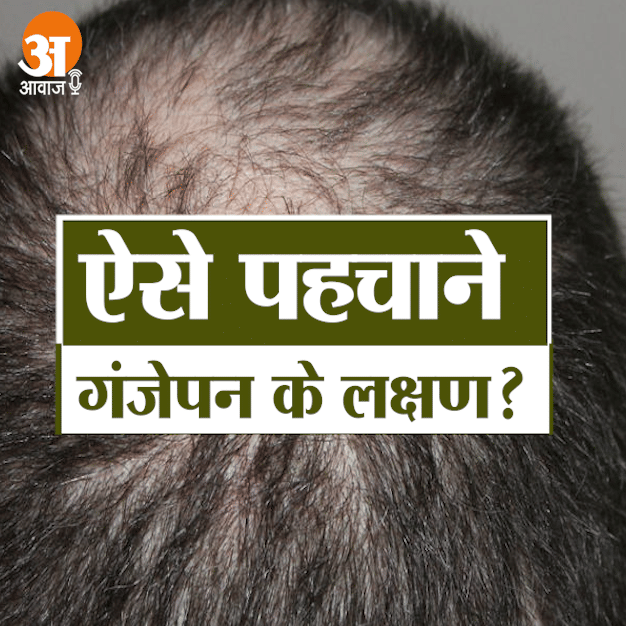what is male pattern baldness?