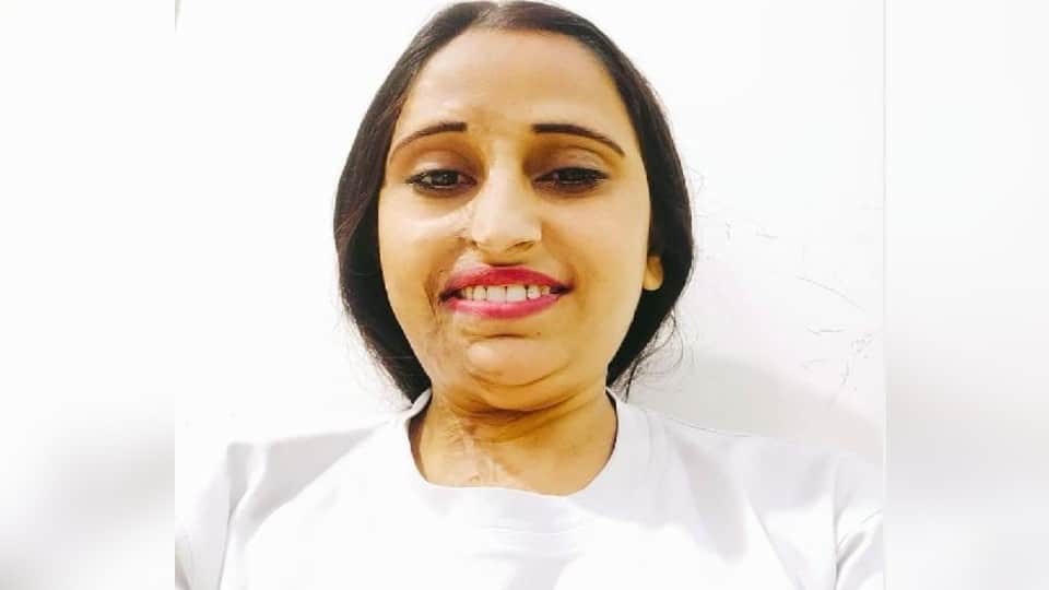 Deepika Padukone Film Chhapaak co-star and acid attack survivor Bala critical condition due to kidney failure