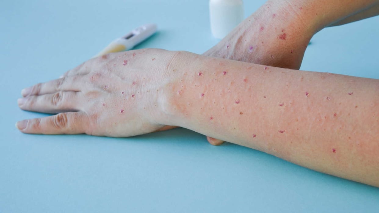 Monkeypox vs Tomato Flu Symptoms and difference, Know How to Identify it in Hindi