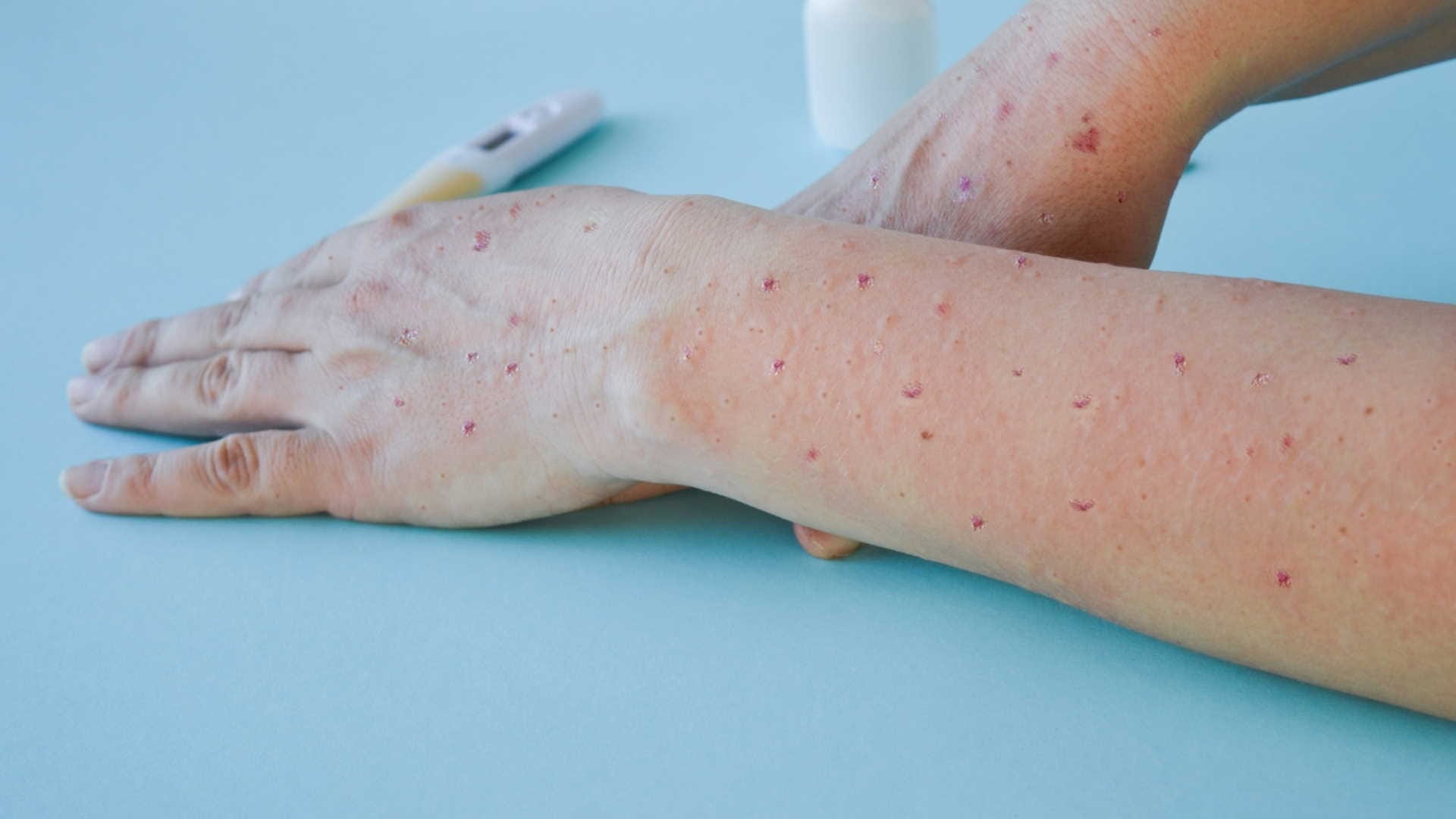 Central Government Advisory on Monkeypox in Hindi Do And Don't To Prevent Monkeypox