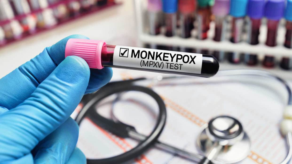 monkeypox alert in india, monkeypox symptoms causes and treatment in hindi