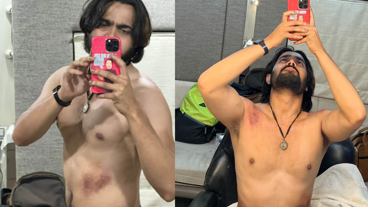 youtuber Bhuvan Bam get injured during web series taaza khabar shooting