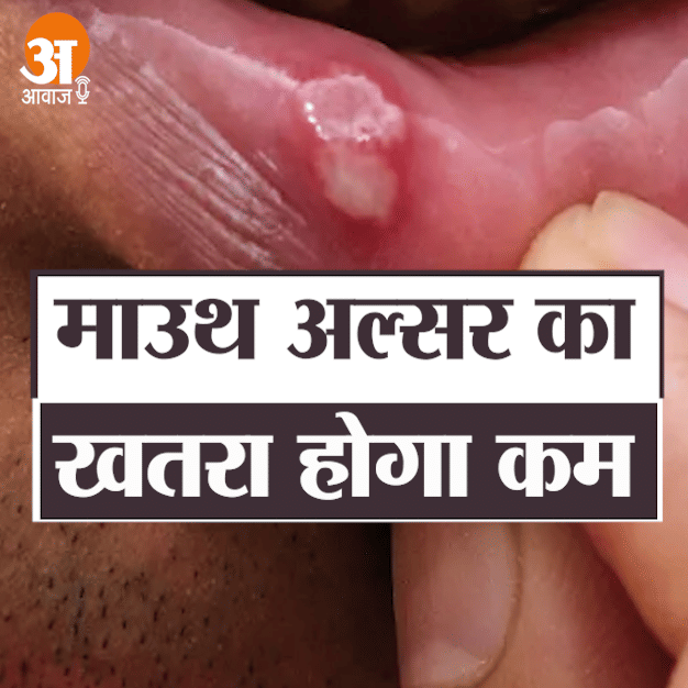 Troubled by mouth ulcer, these home remedies are effective