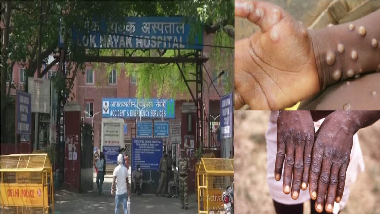 monkeypox in delhi  A case of monkeypox found in Delhi symptoms started appearing two weeks ago