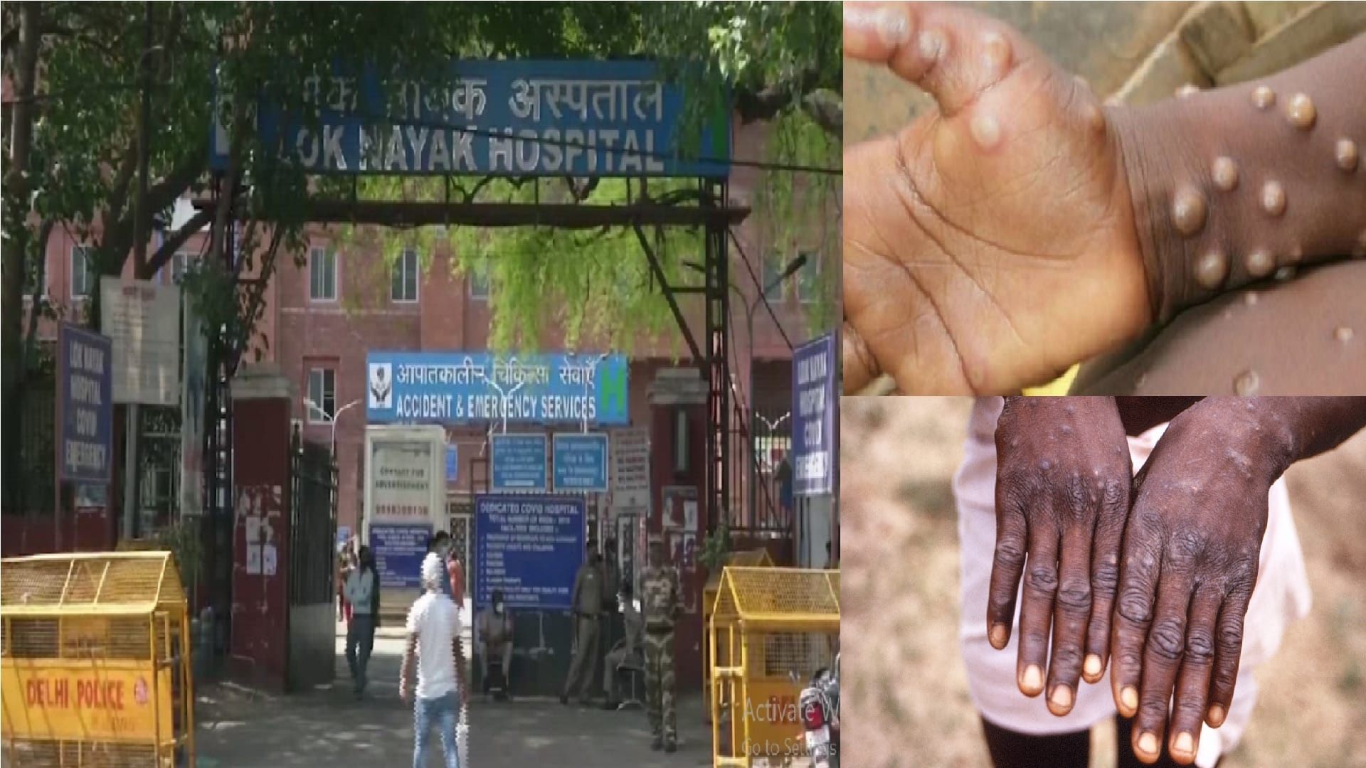 Health Department Issues Monkeypox Guidelines in India in hindi Rules of Monkeypox disease