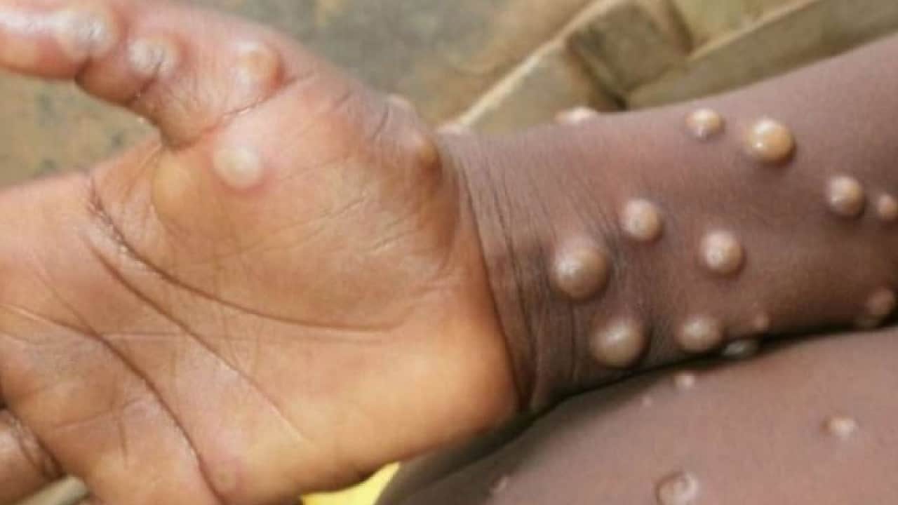 monkeypox in delhi  A case of monkeypox found in Delhi symptoms started appearing two weeks ago