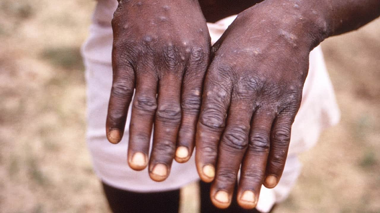 monkeypox in delhi  A case of monkeypox found in Delhi symptoms started appearing two weeks ago