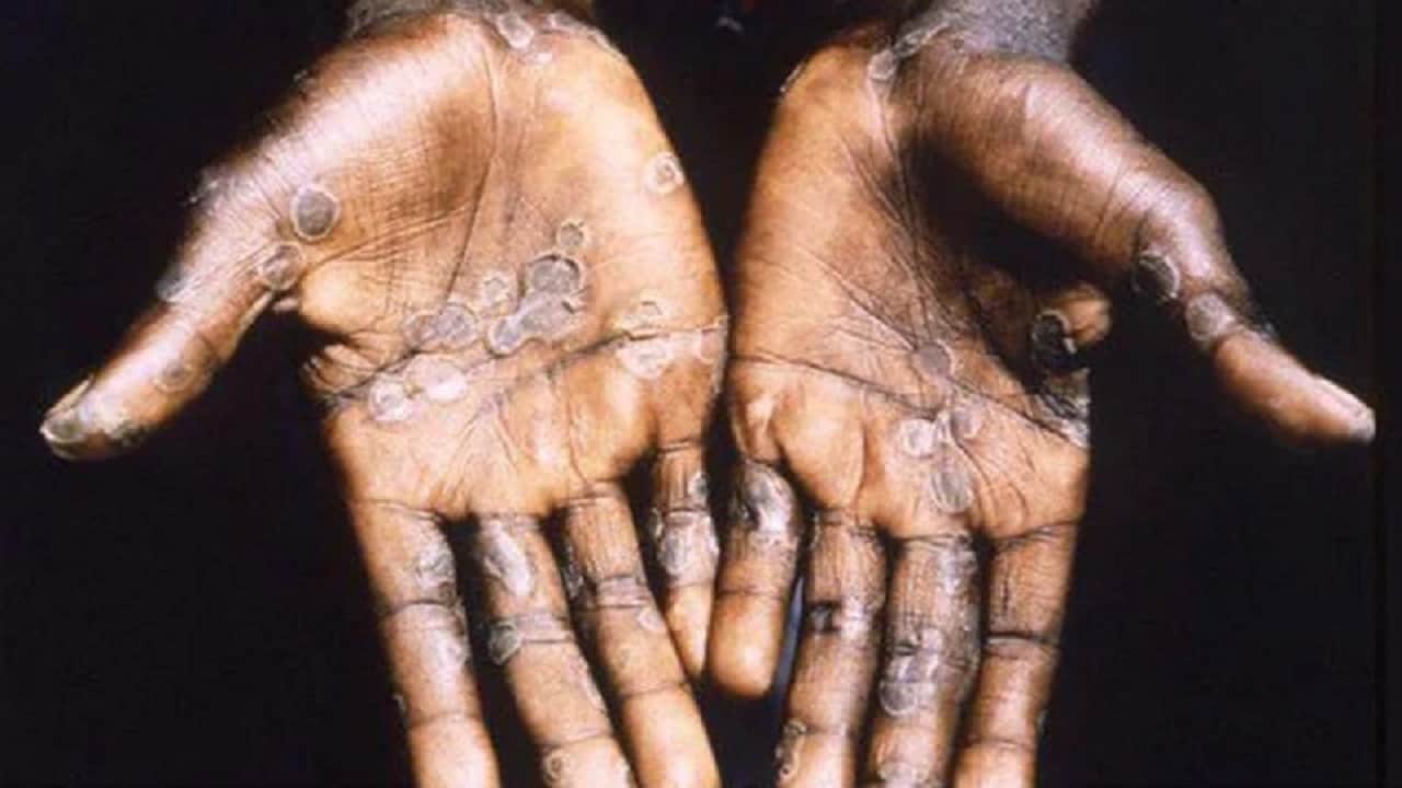 monkeypox in delhi  A case of monkeypox found in Delhi symptoms started appearing two weeks ago