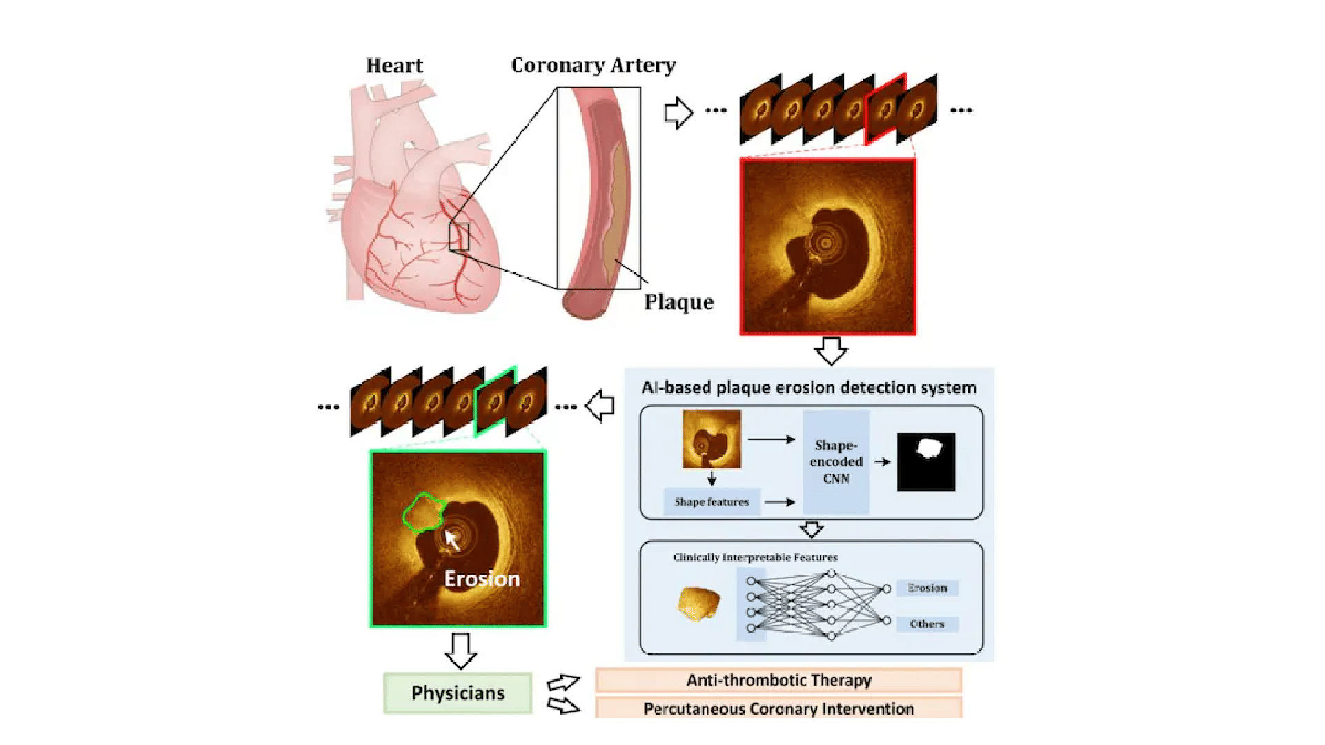 New AI Based Technique Can Detect Heart Conditions also stop Avert Heart Attacks