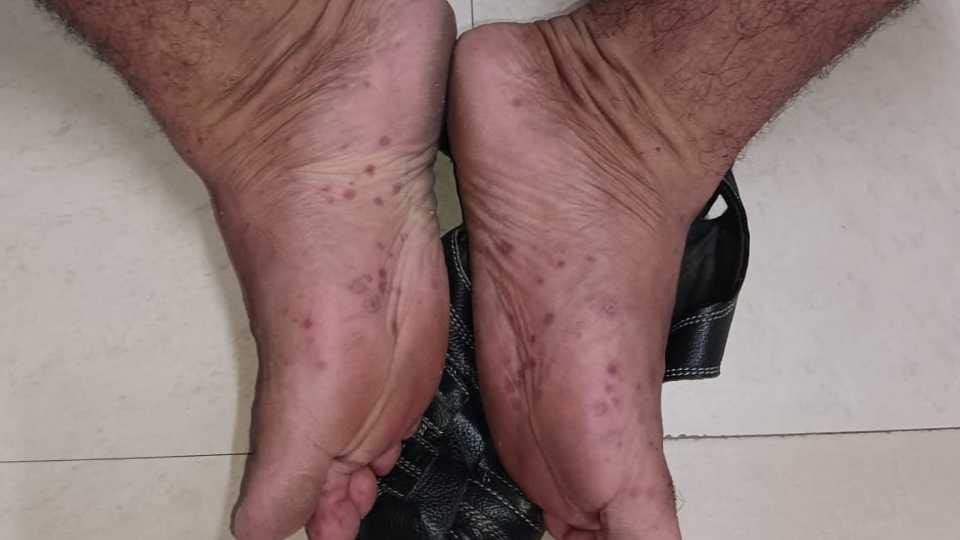 Monkeypox vs Tomato Flu Symptoms and difference, Know How to Identify it in Hindi