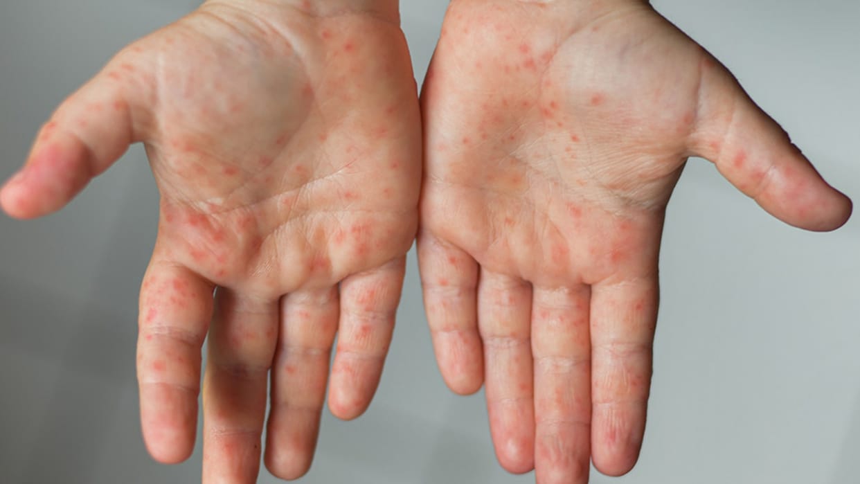 Children infected with hand foot and mouth disease in Bhilwara