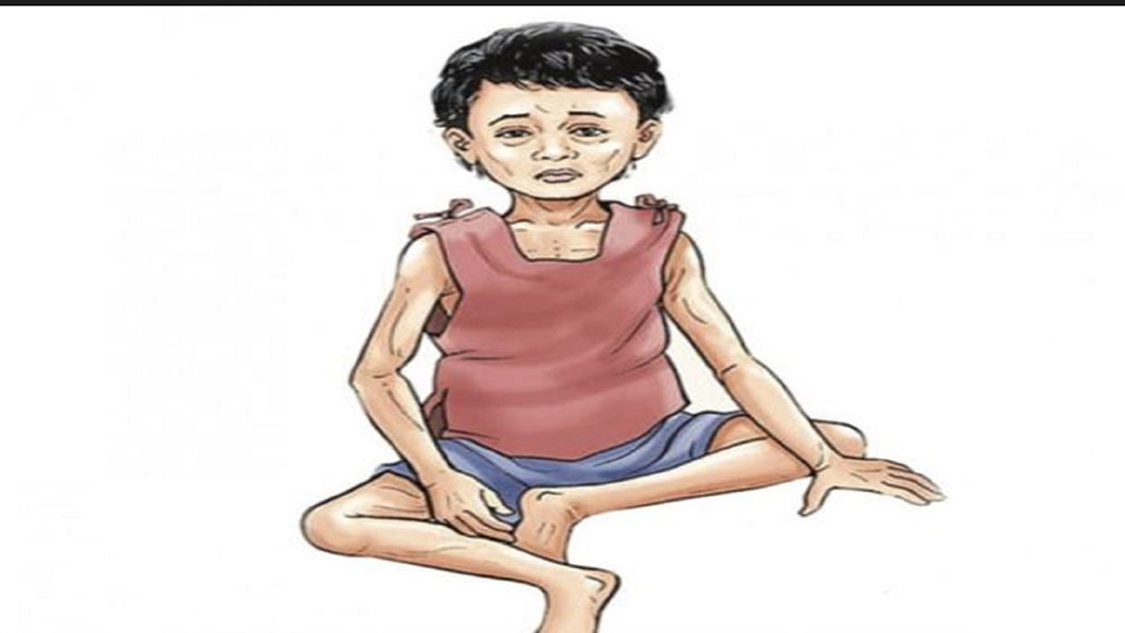 malnourished girl from birth started walking in azamgarh