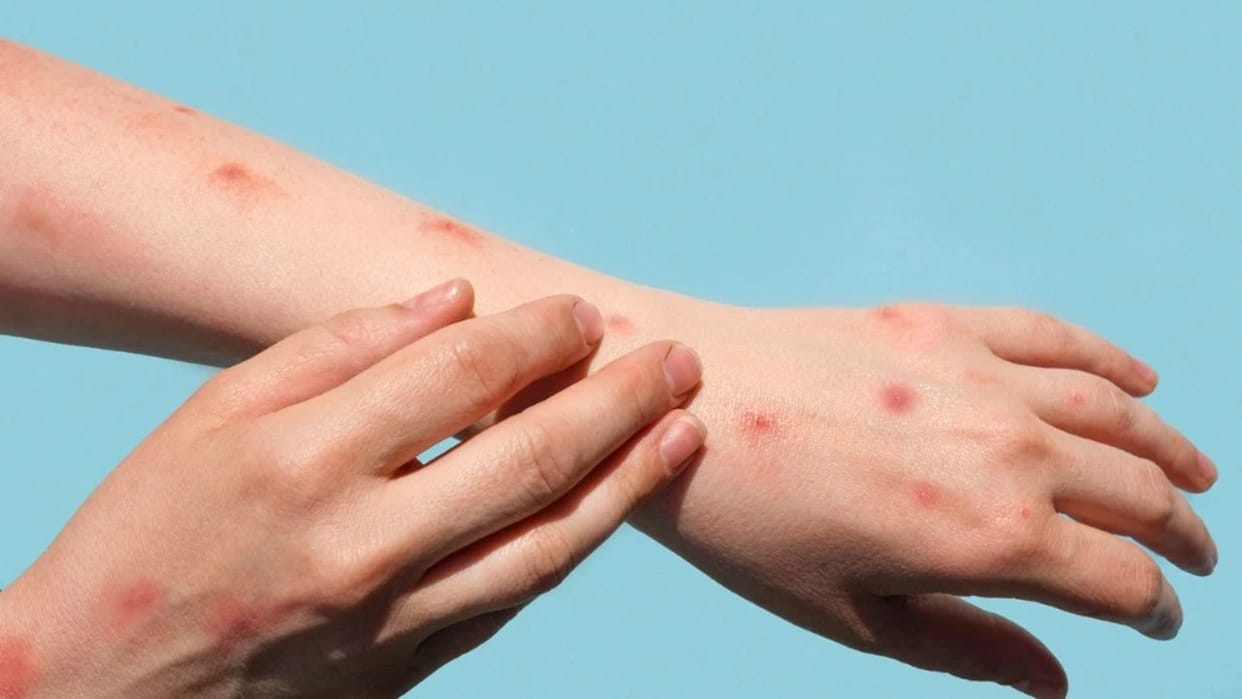 Symptoms of monkey pox found in a woman in Indore, Madhya Pradesh, home isolated