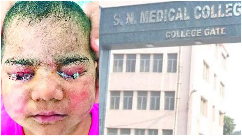 Treatment of innocent girl's eyes with lip membrane in sn medical college agra