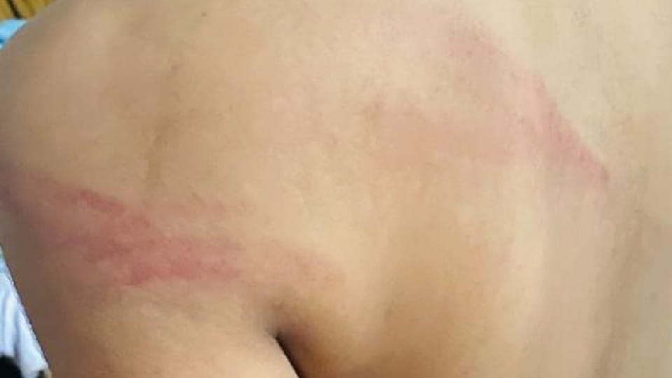 Madhya Pradesh: Third class child brutally beaten up in Sehore for not good handwriting, FIR on teacher