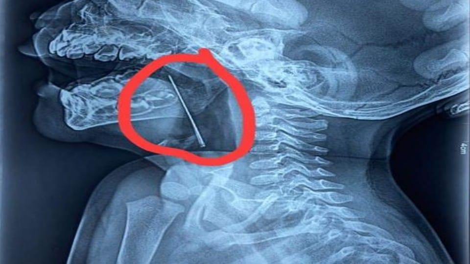 10 month old baby swallowed needle in firozabad