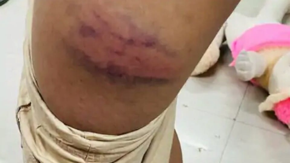 Madhya Pradesh: Third class child brutally beaten up in Sehore for not good handwriting, FIR on teacher