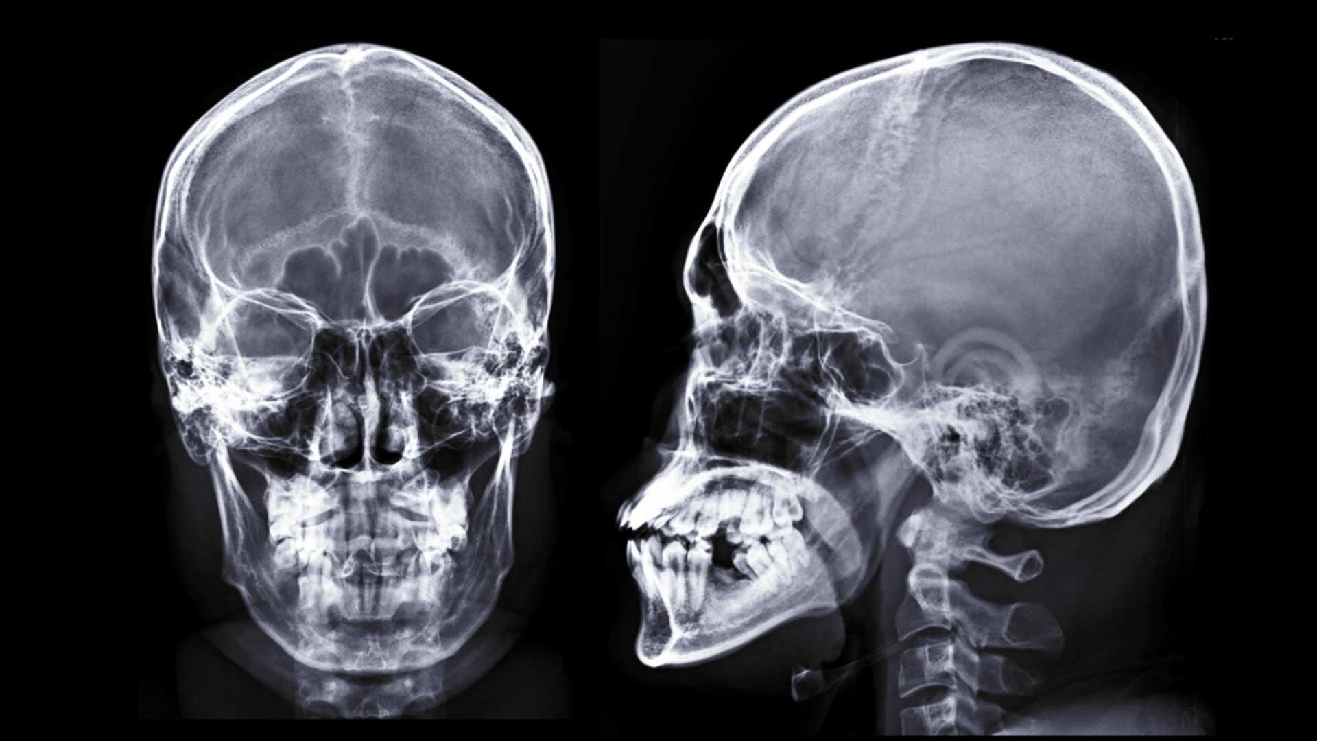 treacher collins syndrome symptoms causes and life expectancy, kno details in hindi