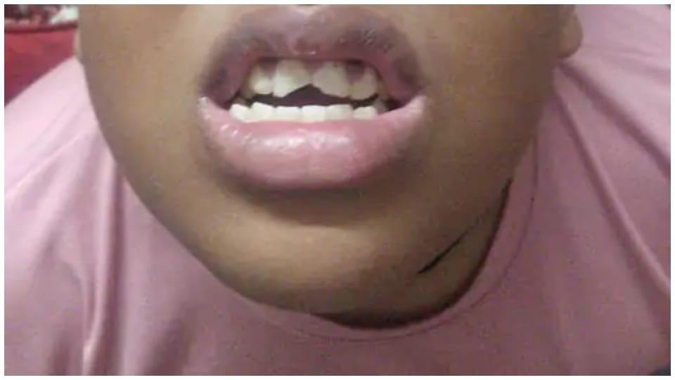 Changes in genes affect the development of children's teeth