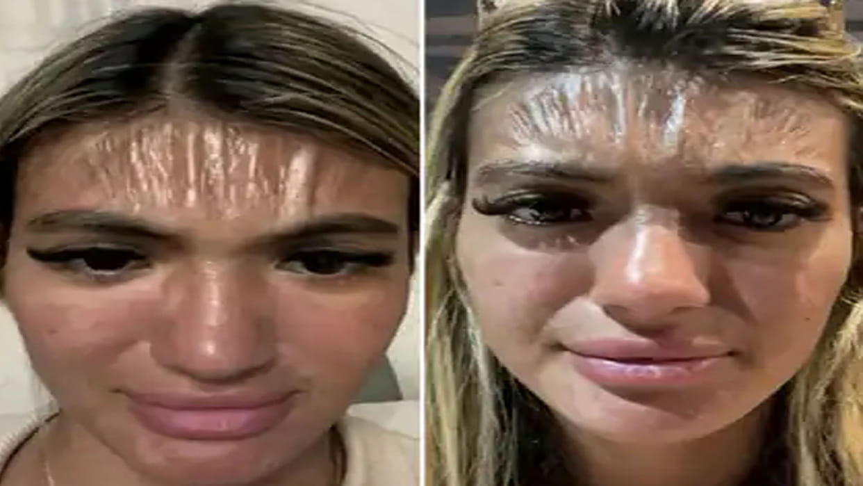 Trending News in Hindi woman fell sleep in sun wakes up with plastic forehead